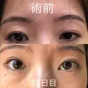 眉下切開 ビクアスクリニック DAY 52 サムネイル用