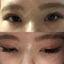 二重埋没 / 下まぶたの脂肪取り / ボトックス（エラ・小顔） 表参道スキンクリニック 表参道院 DAY 7 サムネイル用