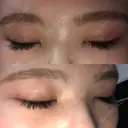 二重埋没 / 下まぶたの脂肪取り / ボトックス（エラ・小顔） 表参道スキンクリニック 表参道院 DAY 7 サムネイル用