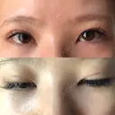 二重埋没 / 下まぶたの脂肪取り / ボトックス（エラ・小顔） 表参道スキンクリニック 表参道院 DAY 8 サムネイル用