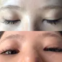 二重埋没 / 下まぶたの脂肪取り / ボトックス（エラ・小顔） 表参道スキンクリニック 表参道院 DAY 8 サムネイル用