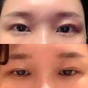 二重埋没 聖心美容クリニック 札幌院 DAY 48 サムネイル用