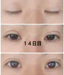 二重埋没 城本クリニック 姫路院 DAY 13 サムネイル用