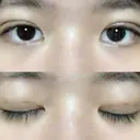 二重埋没 / 眼瞼下垂（切開） アリナガ美容外科 AFTER サムネイル用