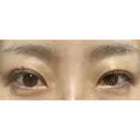 二重埋没 城本クリニック 姫路院 DAY 16 サムネイル用