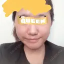 目頭切開 / バッカルファット除去 / 脂肪吸引（顔） / 目尻切開 / タレ目形成・グラマラスライン（切開） / その他（目元） RG整形外科（旧リオン整形外科） DAY 33 サムネイル用