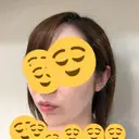 肌ヒアルロン酸注入（たるみ・シワ改善） / ヒアルロン酸注入（あご） ジョウクリニック 松山院 DAY 0 サムネイル用