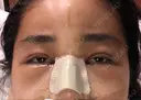 二重埋没 / 目頭切開 ラミチェ美容整形外科 DAY 1 サムネイル用