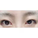 二重埋没 城本クリニック 姫路院 DAY 21 サムネイル用