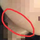 骨切り（あご） / 骨削り（エラ） / 骨削り（頬） ボンディ美容整形外科（旧リオン整形外科） DAY 53 サムネイル用