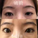 眉下切開 ビクアスクリニック DAY 54 サムネイル用