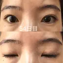 眉下切開 ビクアスクリニック DAY 54 サムネイル用