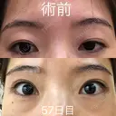 眉下切開 ビクアスクリニック AFTER サムネイル用