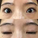 眉下切開 ビクアスクリニック DAY 57 サムネイル用