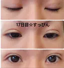 二重埋没 城本クリニック 姫路院 DAY 16 サムネイル用