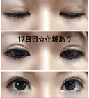 二重埋没 城本クリニック 姫路院 DAY 16 サムネイル用