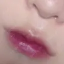 ボトックス（エラ・小顔） / 脂肪溶解注射（顔） / ヒアルロン酸注入（唇） / ボトックス（口角） the way（ザウェイ）整形外科 DAY 17 サムネイル用