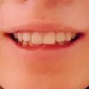 ガミースマイル手術 / その他（口元） 美容皮膚科ピュアビューティー恵比寿 DAY 13 サムネイル用