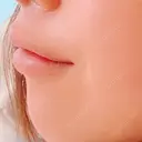 ガミースマイル手術 / その他（口元） 美容皮膚科ピュアビューティー恵比寿 DAY 13 サムネイル用