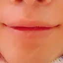 ガミースマイル手術 / その他（口元） 美容皮膚科ピュアビューティー恵比寿 DAY 13 サムネイル用