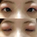 脂肪溶解注射（まぶた） 湘南美容クリニック 高松院 DAY 0 サムネイル用