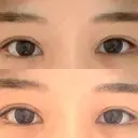 ボトックス（タレ目） フィラークリニック 新宿院 DAY 0 サムネイル用