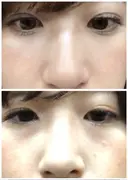 クマ治療 / 下まぶたたるみ取り / 下まぶたの脂肪取り コスメディカルクリニック シンシア 渋谷院 DAY 44 サムネイル用