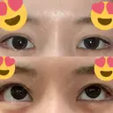 ボトックス（タレ目） フィラークリニック 新宿院 DAY 1 サムネイル用