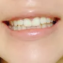 ガミースマイル手術 / その他（口元） 美容皮膚科ピュアビューティー恵比寿 DAY 15 サムネイル用