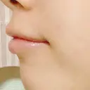 ガミースマイル手術 / その他（口元） 美容皮膚科ピュアビューティー恵比寿 DAY 15 サムネイル用