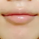 ガミースマイル手術 / その他（口元） 美容皮膚科ピュアビューティー恵比寿 DAY 15 サムネイル用