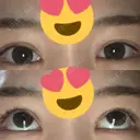 ボトックス（タレ目） フィラークリニック 新宿院 DAY 2 サムネイル用