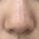 小鼻縮小（切開） 東京ヒルズクリニック 新宿院 DAY 8 サムネイル用