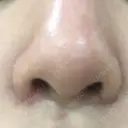 小鼻縮小（切開） 東京ヒルズクリニック 新宿院 DAY 8 サムネイル用