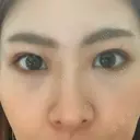 二重埋没 藤・ナチュレ美容クリニック 恵比寿院 DAY 7 サムネイル用