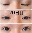 二重埋没 城本クリニック 姫路院 DAY 20 サムネイル用