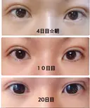 二重埋没 城本クリニック 姫路院 DAY 20 サムネイル用