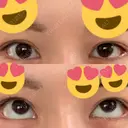 ボトックス（タレ目） フィラークリニック 新宿院 DAY 3 サムネイル用