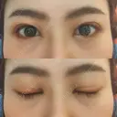 二重埋没 藤・ナチュレ美容クリニック 恵比寿院 DAY 8 サムネイル用