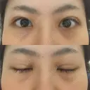 二重埋没 藤・ナチュレ美容クリニック 恵比寿院 DAY 8 サムネイル用