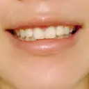 ガミースマイル手術 / その他（口元） 美容皮膚科ピュアビューティー恵比寿 DAY 16 サムネイル用