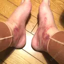 ボトックス（ふくらはぎ） / その他（ボディ） プチパーティー医院 DAY 6 サムネイル用