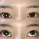 ボトックス（タレ目） フィラークリニック 新宿院 AFTER サムネイル用