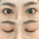 二重埋没 藤・ナチュレ美容クリニック 恵比寿院 DAY 9 サムネイル用