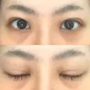 二重埋没 藤・ナチュレ美容クリニック 恵比寿院 DAY 9 サムネイル用