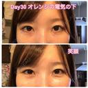 クマ治療 / 下まぶたたるみ取り / 下まぶたの脂肪取り セオリークリニック DAY 30 サムネイル用
