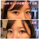 クマ治療 / 下まぶたたるみ取り / 下まぶたの脂肪取り セオリークリニック DAY 30 サムネイル用