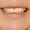 ガミースマイル手術 / その他（口元） 美容皮膚科ピュアビューティー恵比寿 DAY 18 サムネイル用