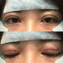 二重埋没 品川美容外科 仙台院 DAY 0 サムネイル用