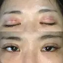 二重埋没 品川美容外科 仙台院 AFTER サムネイル用